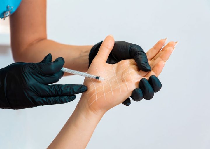 تزریق بوتاکس به کف دست